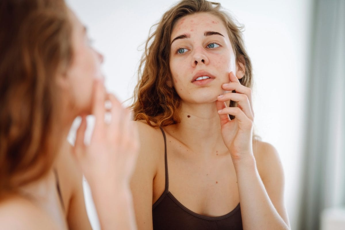Close-up of a young woman looking at pimples in the mirror. Red spots, rash, acne. Skin treatment.