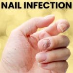 Fungal Nail Infection