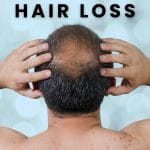 Hair Loss - Male