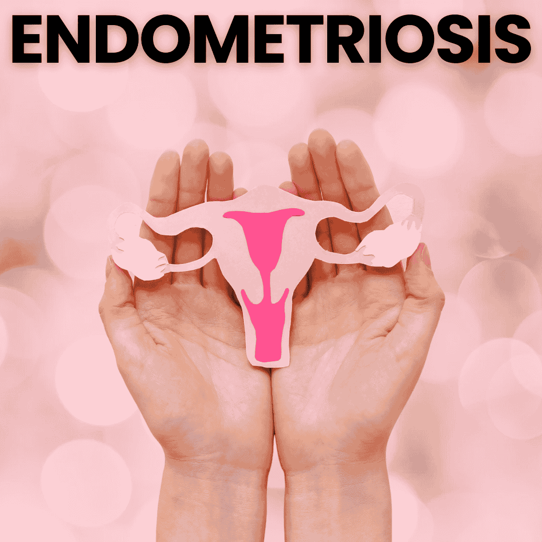 Endometriosis online doctor sa south africa Endometriosis - Image 1