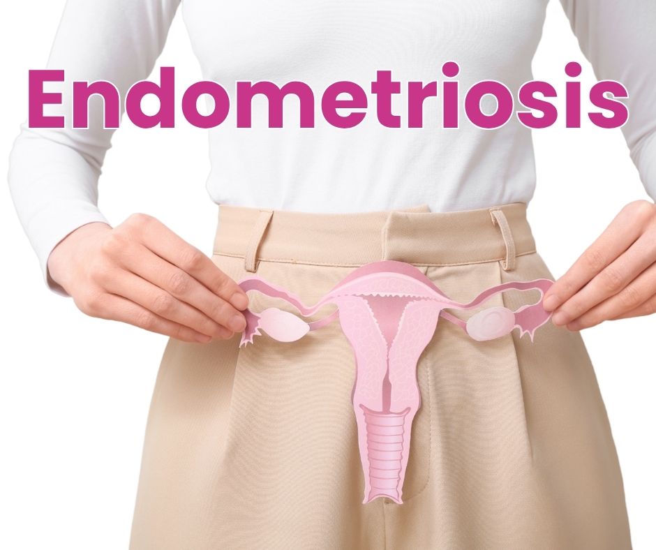 Endometriosis Treatment in South Africa